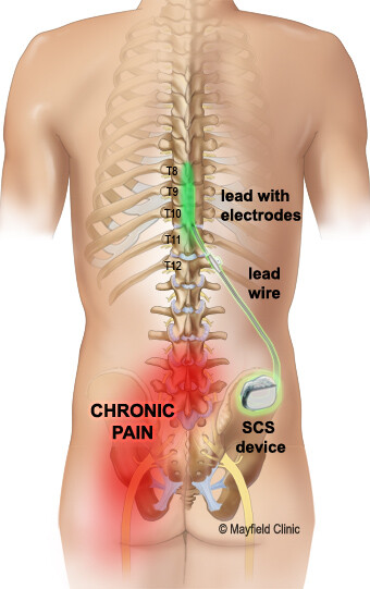 How Does Spinal Cord Stimulation Work?: Florida Pain Medicine